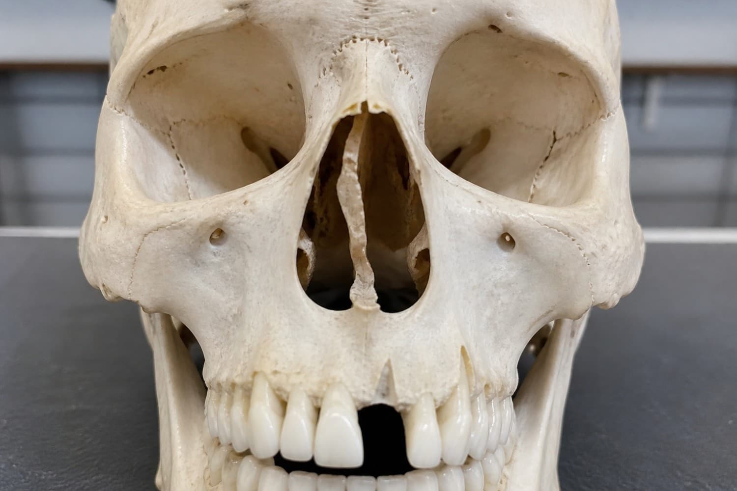 Facial skeleton